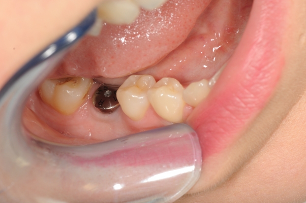 Implantacja dwuetapowa w miejsce braku zęba 46