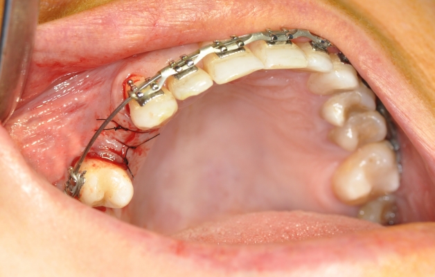 Implantacja z aparatem ortodontycznym 