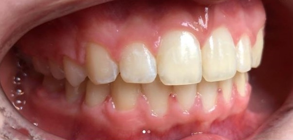 Leczenie ortodontyczne 