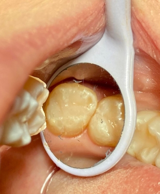 Wypełnienie kompozytowe zęba trzonowego 