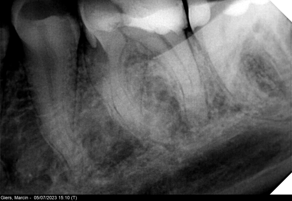 Leczenie kanałowe zęba trzonowego 
