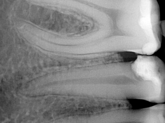 Leczenie kanałowe zęba przedtrzonowego 